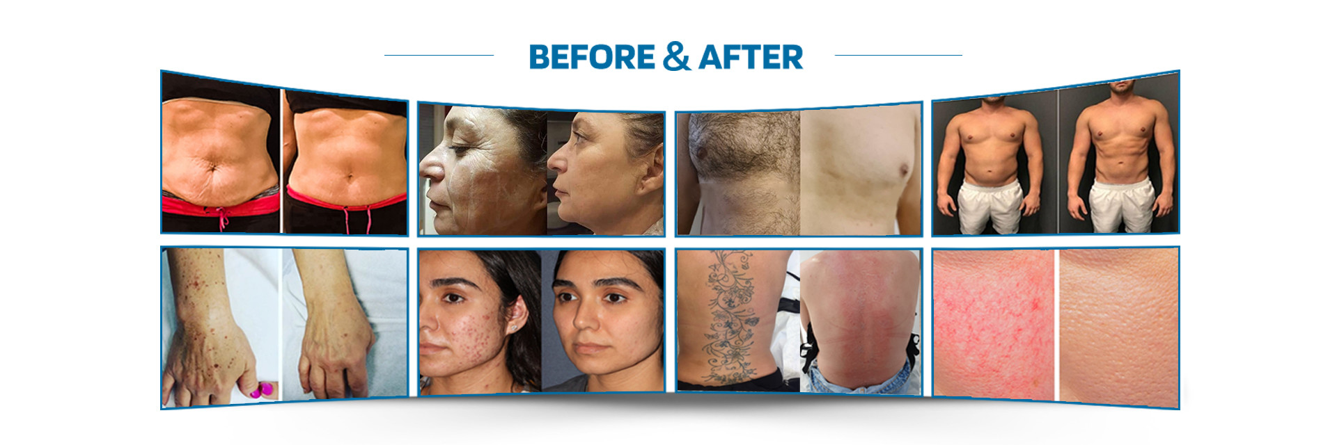 qualidade Máquina da remoção do cabelo do laser fábrica