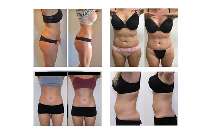 Máquina avançada de lipolaser 6D de lipólise 209mw Super 6d Lipo Laser Liposuction com 635nm 650nm 780nm 810nm 940nm 980nm 6