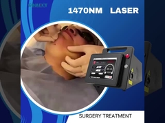 Endolaser 1470 Lifting Lipólise Facial Laser Endovenoso Remoção da Veia Aranha